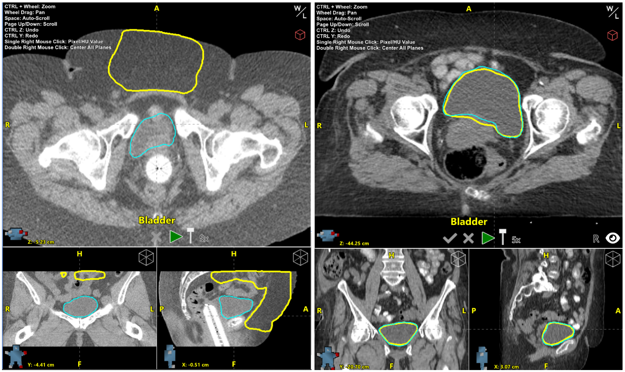 Bladder Rectum F