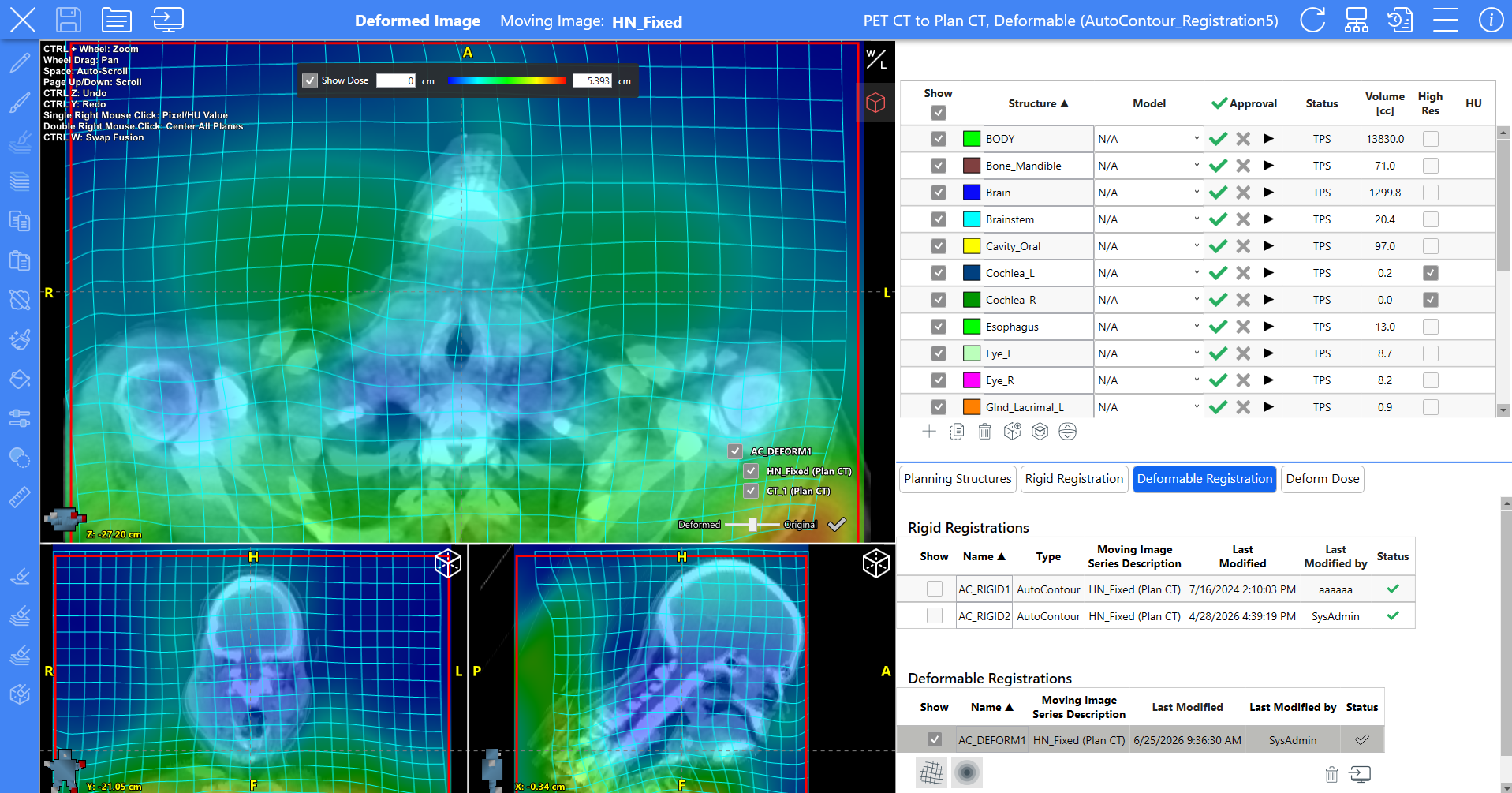 Representative image of deformable heat map in AutoContour