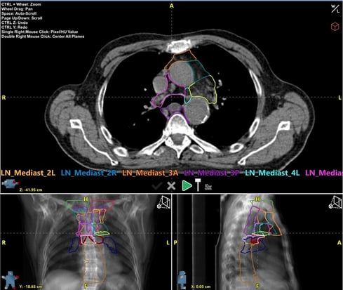 Mediastinal LNs Model Names