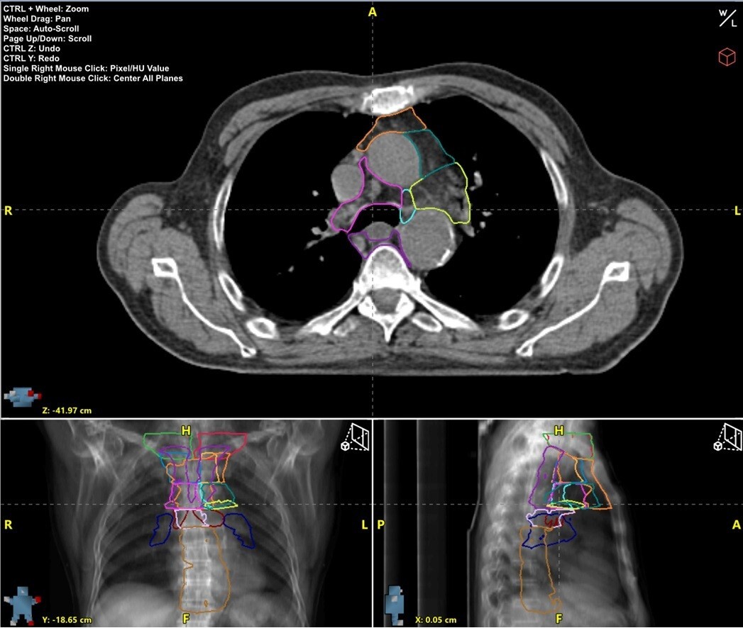 Mediastinal lymph node models in the new AutoContour v2.8