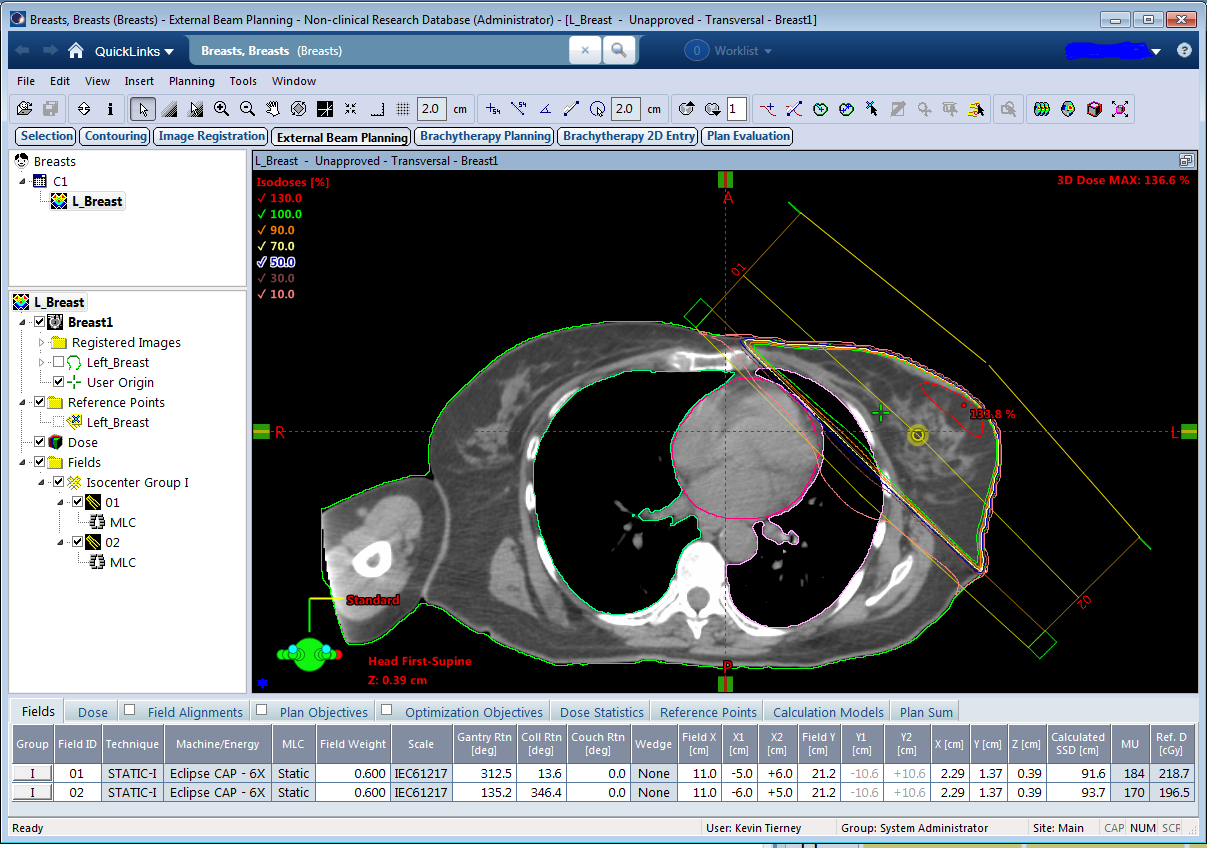 Comparison of isodose distributions seen for left and right breast with