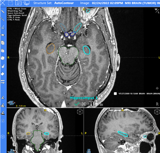 Deformable Registration, Chart Rounds, and More: AutoContour and ...